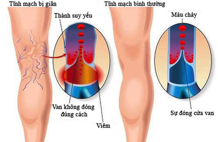 Hình ảnh chân bị giãn tĩnh mạch.