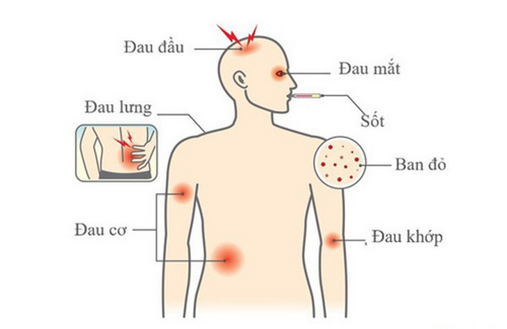 Một số triệu chứng sốt xuất huyết.