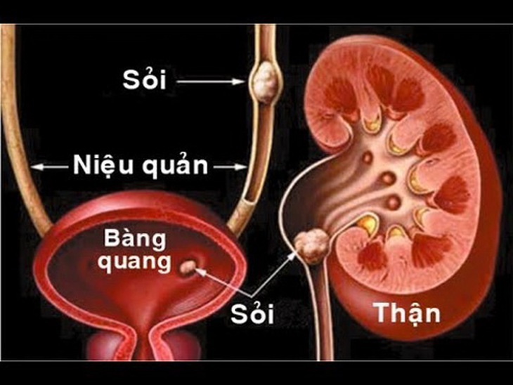 Hình ảnh sỏi tiết niệu.