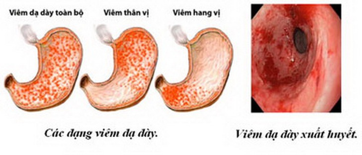Các dạng viêm loét dạ dày.