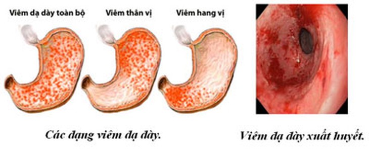Viêm loét dạ dày có nguy hiểm?