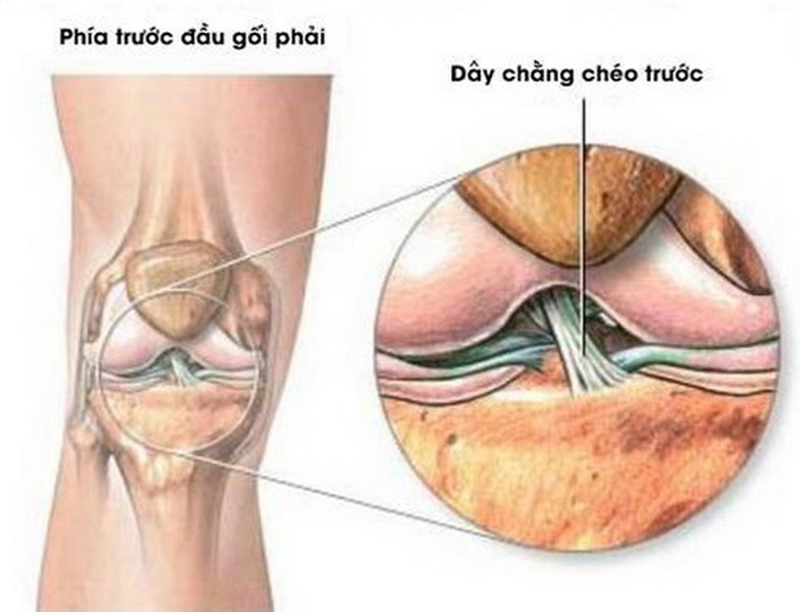 Tổn thương đứt dây chằng đầu gối.