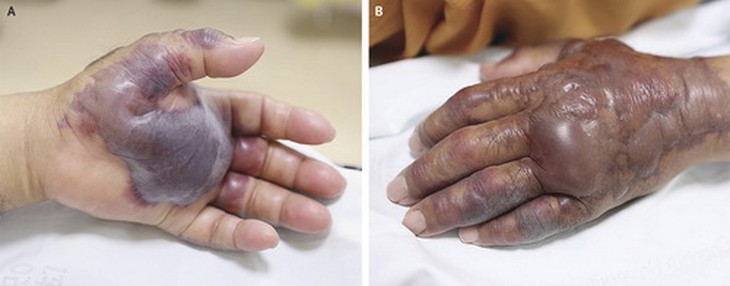 Tay của người nhiễm khuẩn Vibrio vulnificus.