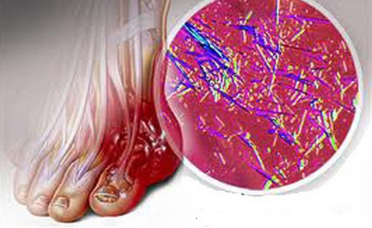 Tinh thể acid uric đọng lại ở khớp ngón chân.