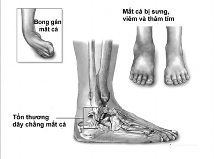 Những chấn thương dễ dẫn đến bong gân.
