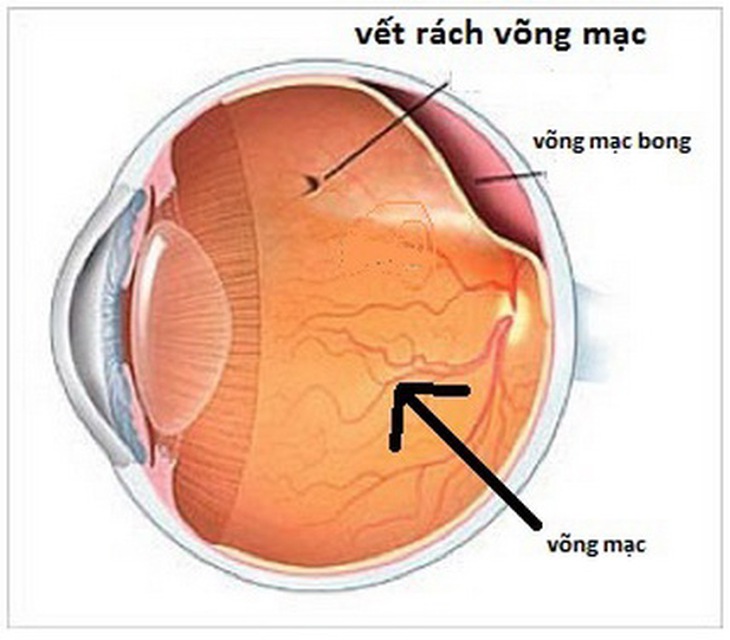 Bong võng mạc.