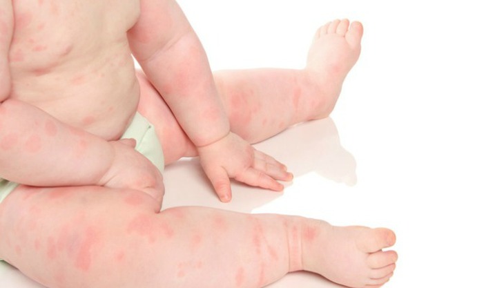 Phân biệt triệu chứng dị ứng và cảm lạnh ở trẻ