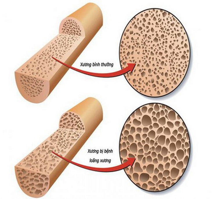 Ngừng sử dụng thuốc trị loãng xương có thể gia tăng nguy cơ gãy xương.