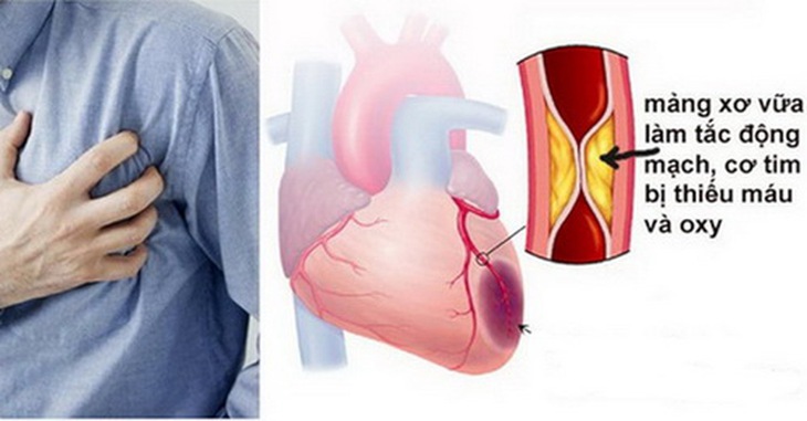 Khi động mạch của cơ quan nào bị xơ vữa sẽ phát triển bệnh ở cơ quan đó.