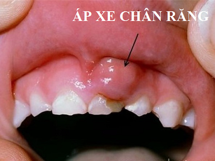 Hình ảnh áp-xe chân răng.