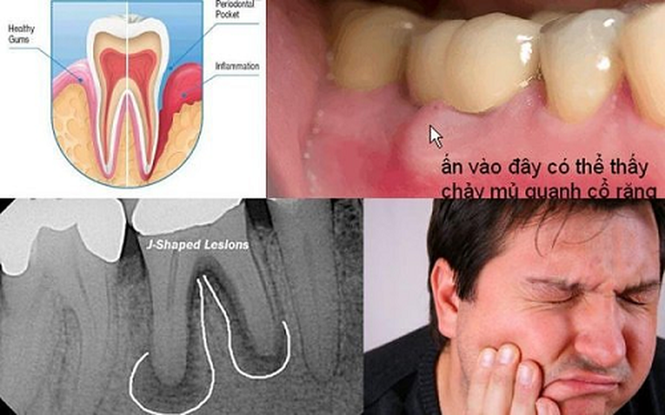 Dấu hiệu áp-xe răng.