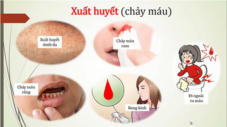 Người bệnh SXH cần theo dõi chặt chẽ, tránh biến chứng nguy hiểm.