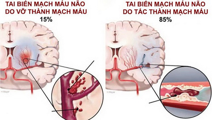 Tai biến mạch máu não một bệnh lý nguy hiểm.