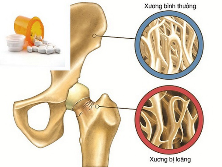 Cần thận trọng khi dùng thuốc trị loãng xương.