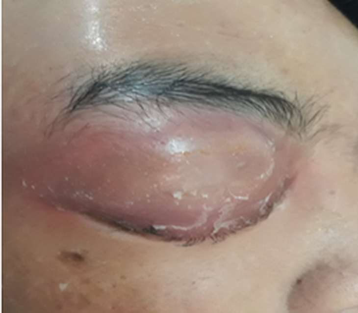 Tình trạng viêm mô hốc mắt phải nghiêm trọng của bệnh nhi trước phẫu thuật.