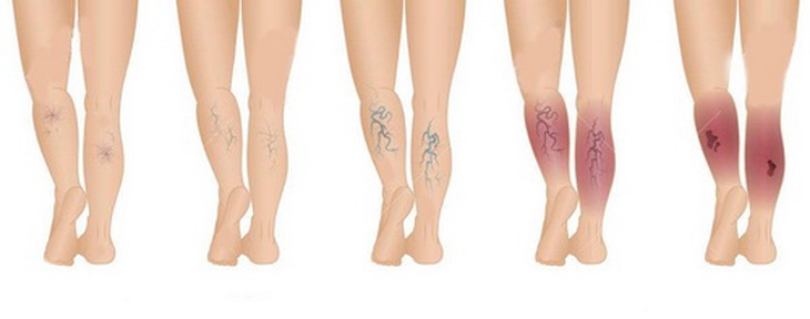 Các bước tiến triển của suy giãn tĩnh mạch chân.