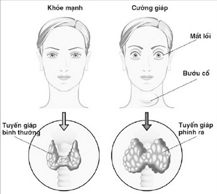 Biến chứng bệnh tuyến giáp ảnh hưởng mắt.