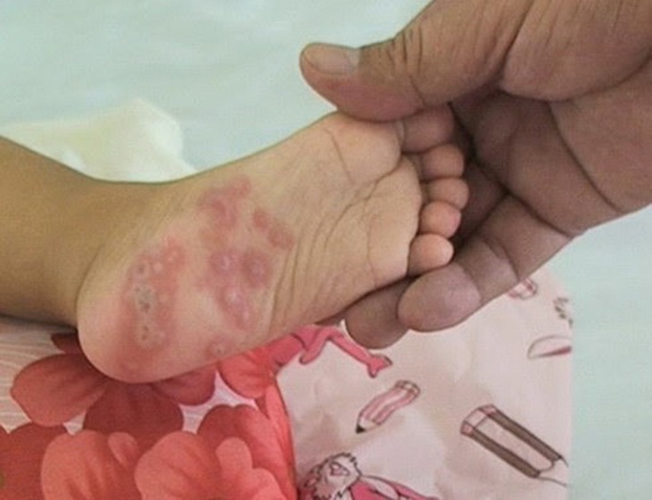 Biểu hiện nhiễm nấm da bàn chân là dạng bong vẩy da chân. Khi đó bàn chân có màu đỏ kèm bong nhiều vẩy trắng.