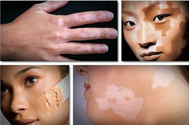 Triệu chứng của bệnh bạch biến.
