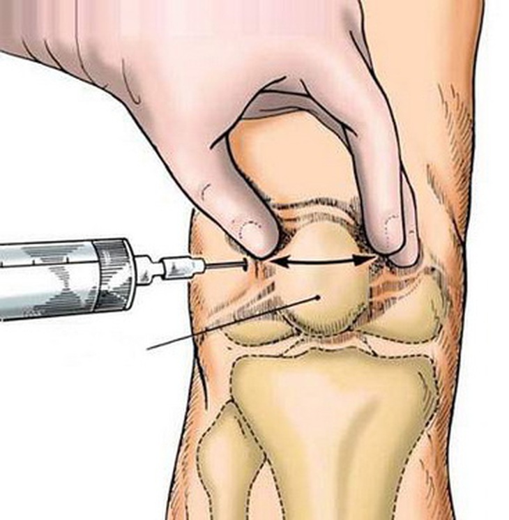 Cần cân nhắc kỹ giữa lợi ích và nguy cơ khi tiêm corticoid vào khớp.