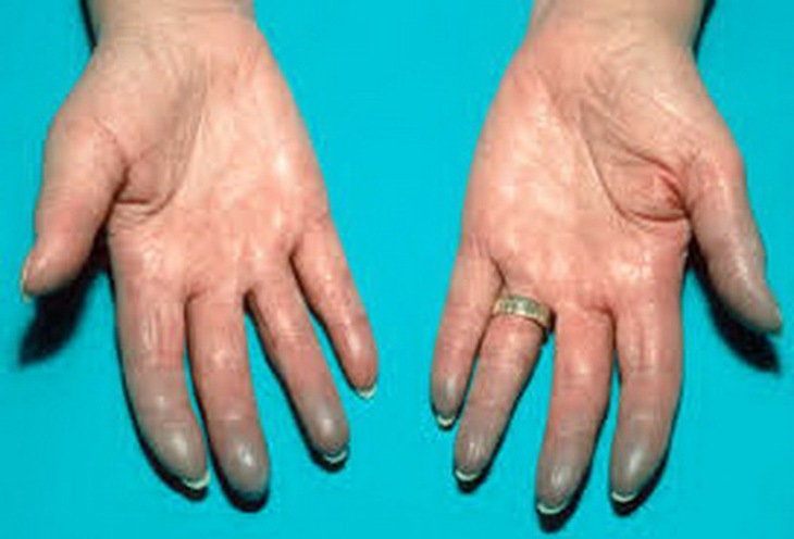 Hội chứng Raynaud với biểu hiện tím các đầu chi.