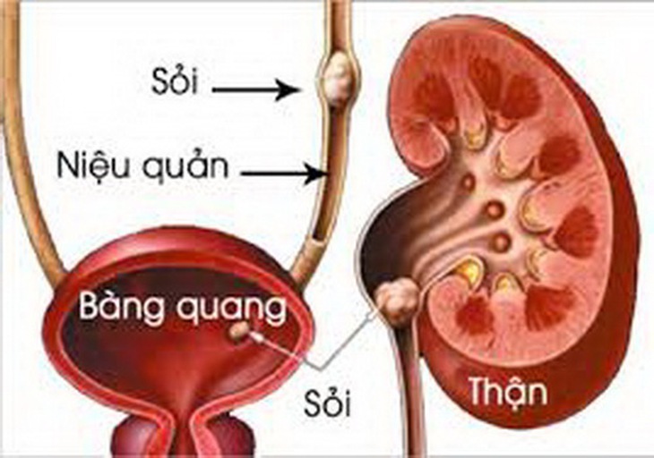 Hình ảnh sỏi thận.