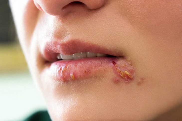 Người nhiễm Herpes ở miệng, khu vực sinh dục... có thể lây sang người lành qua quan hệ tình dục.
