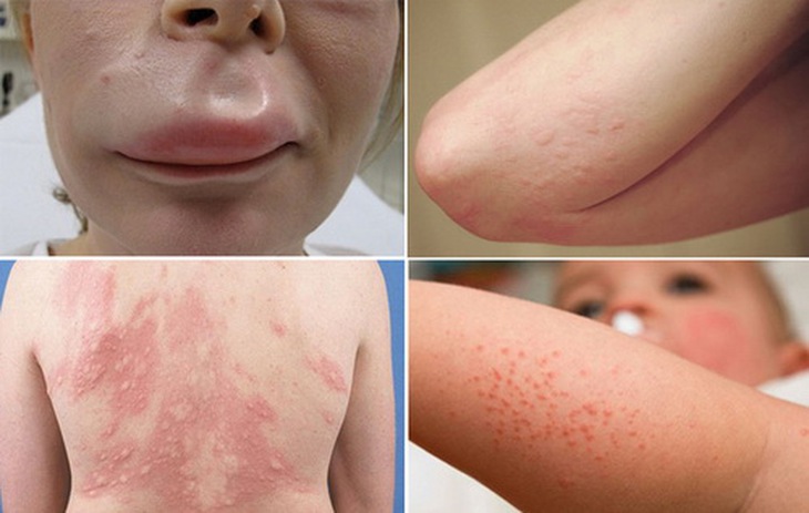 Dị ứng thời tiết đặc trưng bởi những dấu hiệu nổi mề đay, mẩn đỏ...