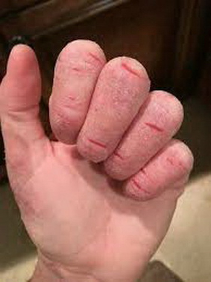 Viêm da tiếp xúc là bệnh phổ biến về da.