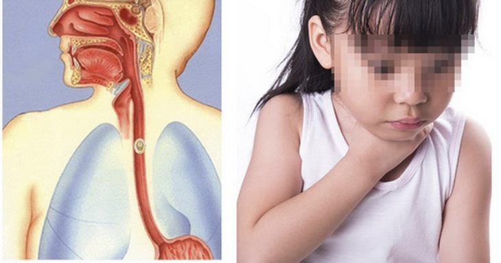 Hóc dị vật ở trẻ nhỏ là tình trạng rất nguy hiểm nếu không có biện pháp xử trí kịp thời.