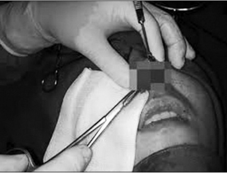 Một ca biến chứng do tiêm filler.