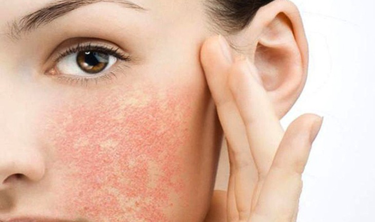 Chăm sóc và chữa trị da bị dị ứng mỹ phẩm