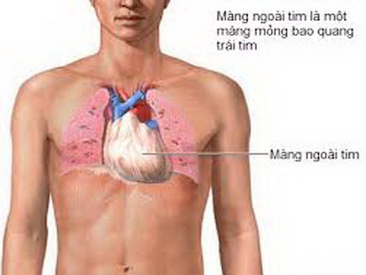 Lao là nguyên nhân hàng đầu gây viêm màng ngoài tim co thắt.