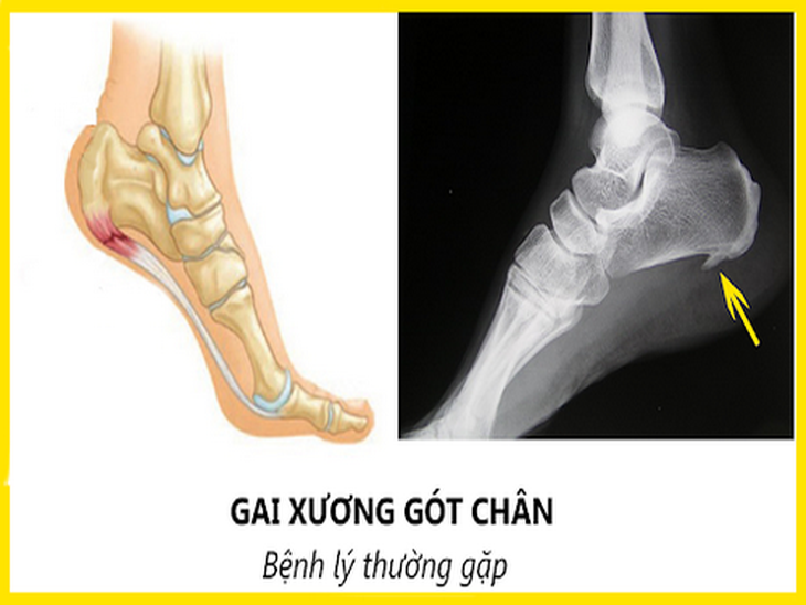 Thường xuyên đau gót chân, bệnh gì?