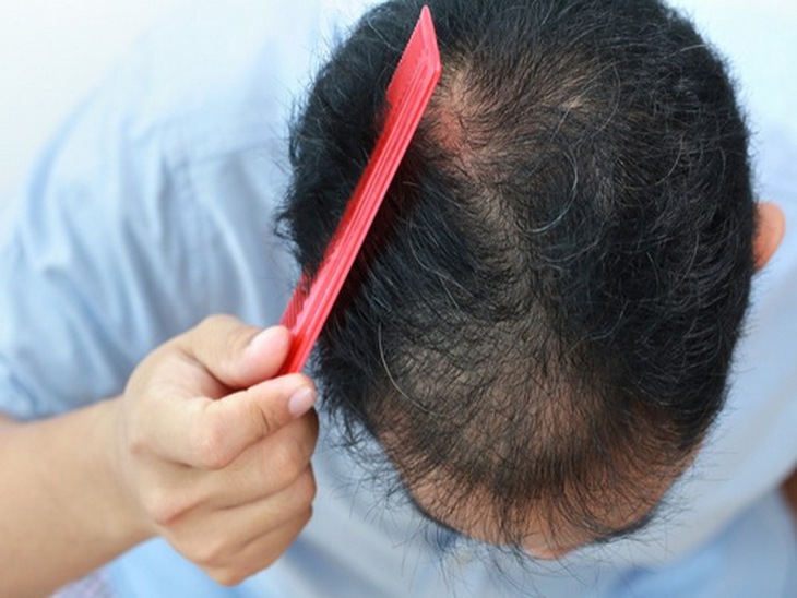 Rụng tóc là biến chứng khá phổ biến ở bệnh nhân đái tháo đường.