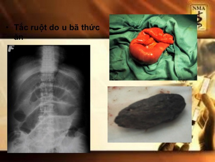 Tắc ruột do bã thức ăn.