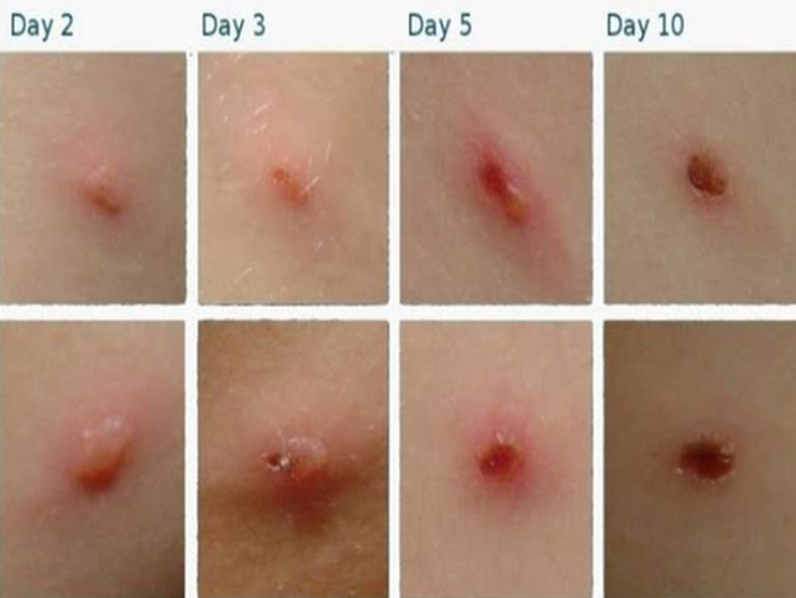Tiến triển của bệnh zona thần kinh.