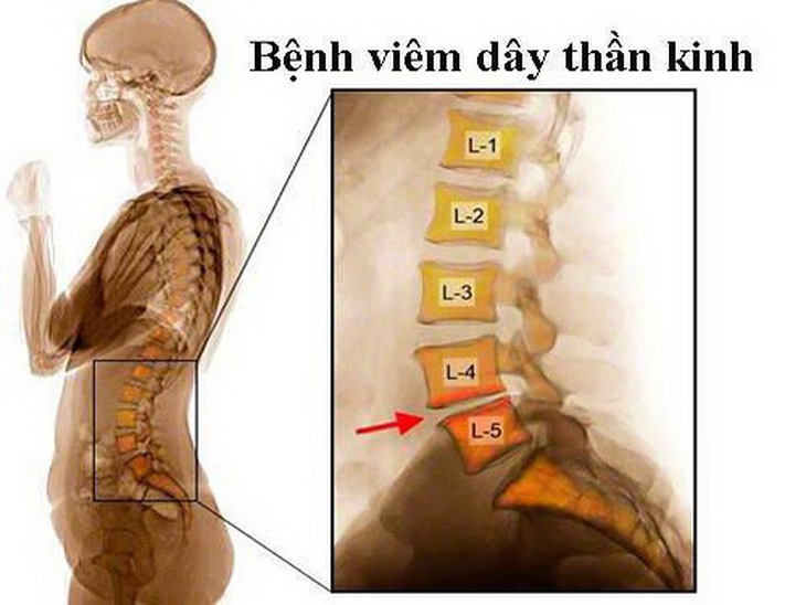 Thoát vị đĩa đệm là một nguyên nhân gây đau dây thần kinh hông.