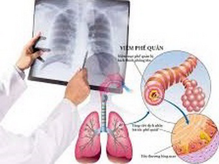 Viêm phế quản mạn tính thường gặp ở người cao tuổi.