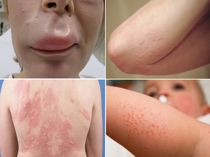 Dị ứng thời tiết đặc trưng bởi những dấu hiệu nổi mề đay, mẩn đỏ...