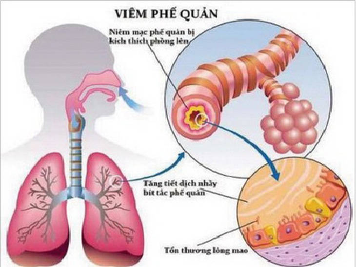 Hình ảnh phế quản bị viêm.