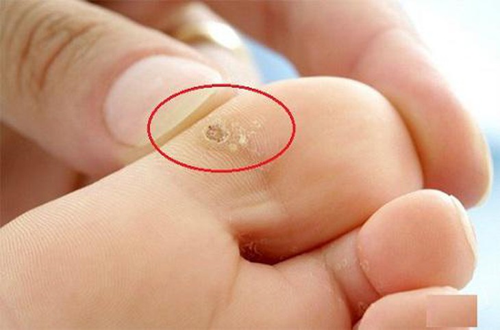Cách chữa mụn cóc