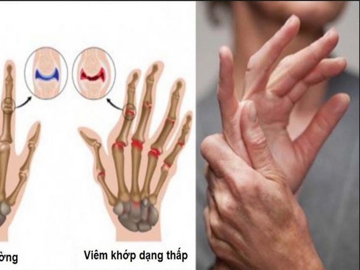 Viêm khớp dạng thấp thường kéo dài, có những đợt tiến triển cấp tính gây đỏ, sưng dẫn đến đau và xơ cứng khớp...