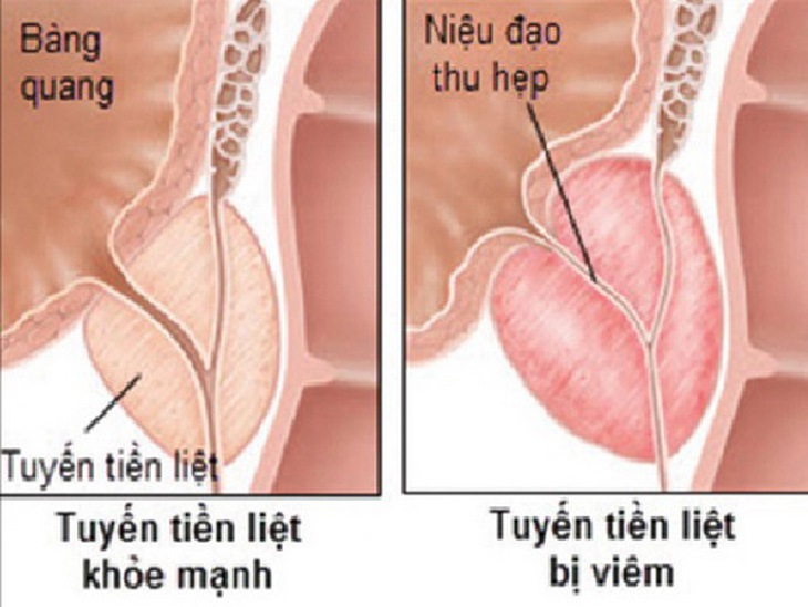 Hán liên thảo phối hợp với vị thuốc khác chữa viêm tuyến tiền liệt.