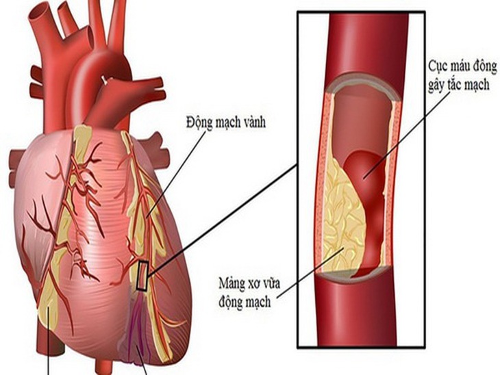 Cơn đau thắt ngực ổn định xuất hiện khi cơ tim không đủ cung cấp lượng máu cần thiết.