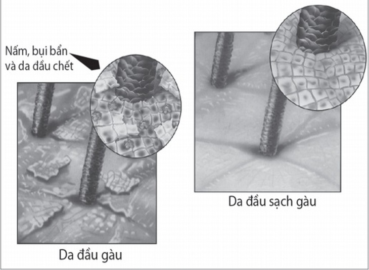 Hình ảnh gàu da đầu.