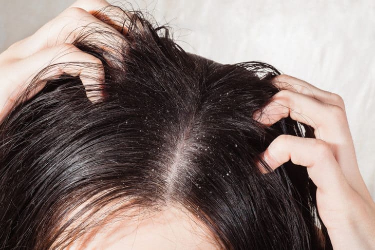 Viêm da tiết bã da đầu gây gàu nhiều, dễ tái phát kéo dài- Ảnh 1.