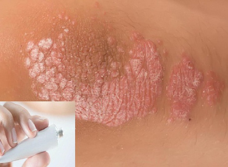 Chỉ dùng thuốc trị vẩy nến theo chỉ định của bác sĩ.