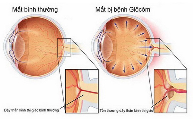 Mắt bình thường và mắt bị glôcôm.