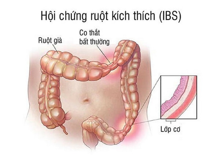 Hội chứng ruột kích thích là một rối loạn tiêu hóa có thể ảnh hưởng đến chất lượng cuộc sống.